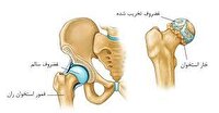 تعویض موفق مفصل لگن بانوی ۷۷ ساله در هرمزگان